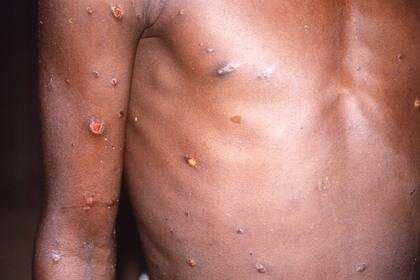 ARCHIVO - Esta imagen de 1997 facilitada por los Centros para el Control y la Prevención de Enfermedades de Estados Unidos (CDC por sus siglas en inglés) muestra a una persona con lesiones en la piel en lo que es un caso activo de viruela símica. (CDC via AP, File)