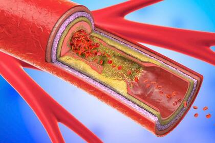 Cuando el glicocálix desaparece se inicia la aterosclerosis (acumulación de grasas, colesterol y otras sustancias dentro de las arterias y sobre sus paredes).