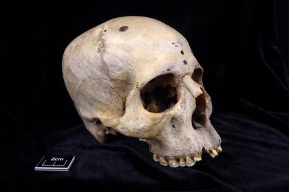 El cráneo de un hombre de entre 30 y 35 años, datado entre 2687 y 2345 a.C., presentaba marcas de corte en los bordes del cráneo alrededor de decenas de lesiones derivadas de un cáncer cerebral metastásico