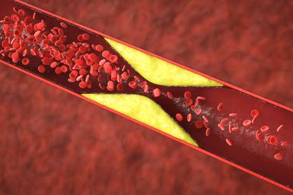 Las placas ateroscleróticas se pueden romper, liberando su contenido y activando la coagulación y la formación de trombos que obstruyen el flujo sanguíneo