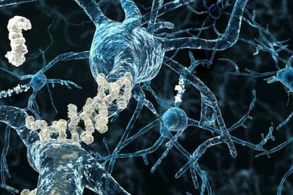 Las placas de amiloide (mostradas aquí en blanco) son visibles en las neuronas afectadas por la enfermedad de Alzheimer
