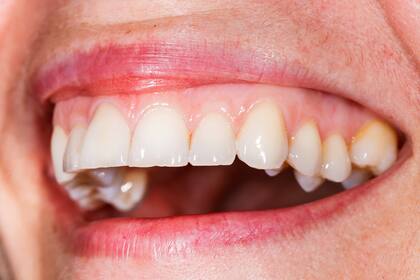 Una mala higiene dental puede aumentar el riesgo de cáncer oral